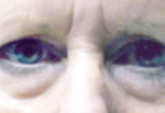 Lower Eyelids Before & After Patient #944