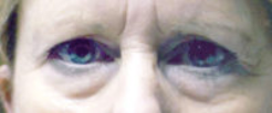 Lower Eyelids Before & After Patient #944