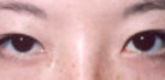 Asian Eyes Before & After Patient #977
