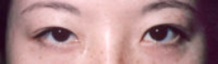 Asian Eyes Before & After Patient #977