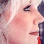 Non-Surgical Facelifts Before & After Patient #819