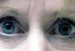 Lower Eyelids Before & After Patient #944