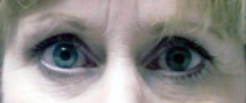 Lower Eyelids Before & After Patient #944