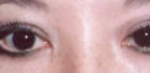 Asian Eyes Before & After Patient #977