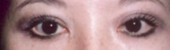 Asian Eyes Before & After Patient #977