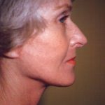 Facial Rejuvenation Before & After Patient #121
