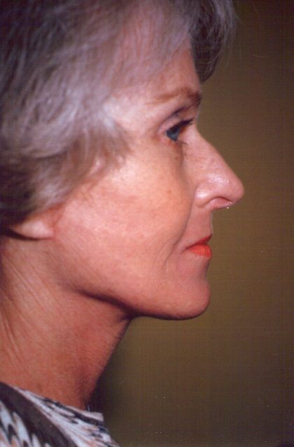 Facial Rejuvenation Before & After Patient #121