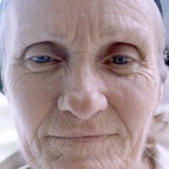 Non-Surgical Facelifts Before & After Patient #816