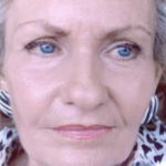 Non-Surgical Facelifts Before & After Patient #816