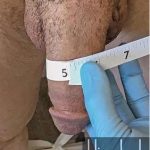 Himplant Before & After Patient #1296
