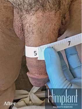 Himplant Before & After Patient #1296