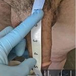 Himplant Before & After Patient #1299