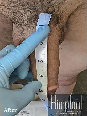 Himplant Before & After Patient #1299