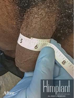 Himplant Before & After Patient #1308