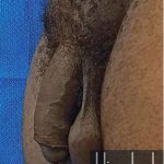 Himplant Before & After Patient #1314