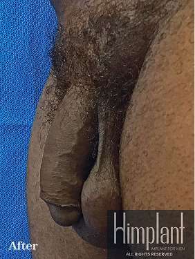 Himplant Before & After Patient #1314