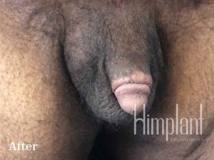 Retracted Buried Penis Before & After Patient #1263