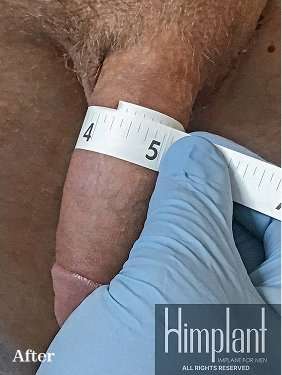 Himplant Before & After Patient #1320