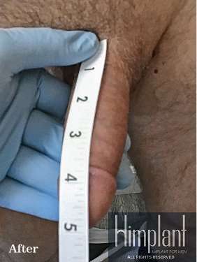 Himplant Before & After Patient #1323