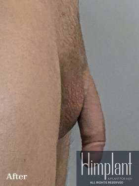 Himplant Before & After Patient #1326