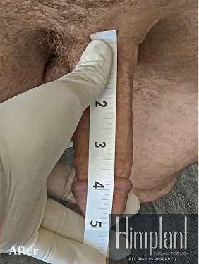 Himplant Before & After Patient #1347