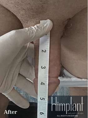 Himplant Before & After Patient #1371
