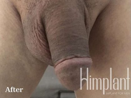 Retracted Buried Penis Before & After Patient #1257
