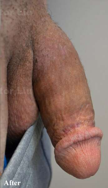 Permanent Penis Enlargement Before & After Patient #1392