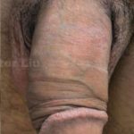 Permanent Penis Enlargement Before & After Patient #1395