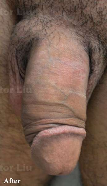Permanent Penis Enlargement Before & After Patient #1395