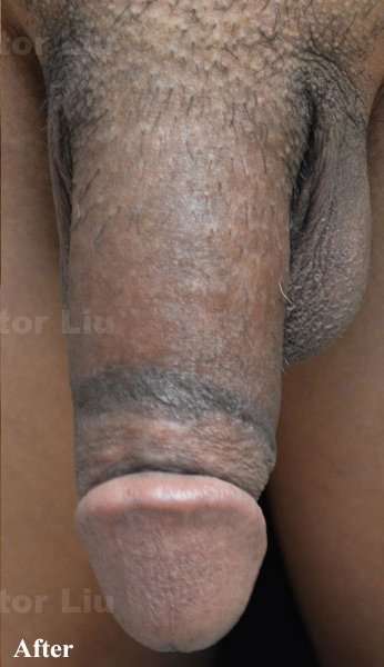 Permanent Penis Enlargement Before & After Patient #1398
