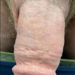 Permanent Penis Enlargement Before & After Patient #1401