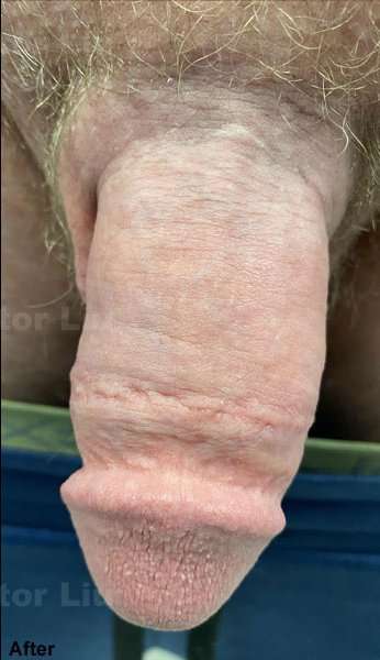 Permanent Penis Enlargement Before & After Patient #1401