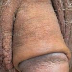 Permanent Penis Enlargement Before & After Patient #1404