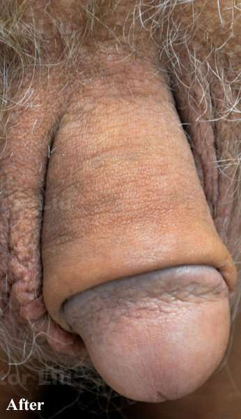 Permanent Penis Enlargement Before & After Patient #1404