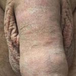 Permanent Penis Enlargement Before & After Patient #1407