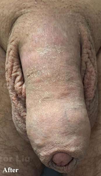 Permanent Penis Enlargement Before & After Patient #1407