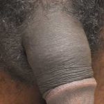 Permanent Penis Enlargement Before & After Patient #1413