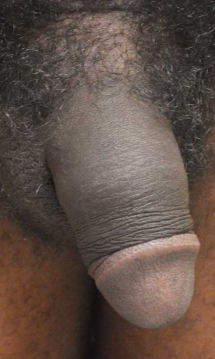 Permanent Penis Enlargement Before & After Patient #1413