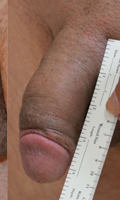 Permanent Penis Enlargement Before & After Patient #1419