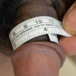 Permanent Penis Enlargement Before & After Patient #1425