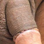 Permanent Penis Enlargement Before & After Patient #1428