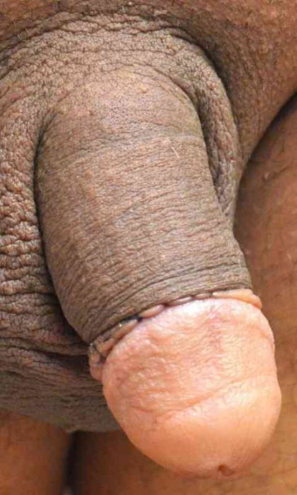 Permanent Penis Enlargement Before & After Patient #1428