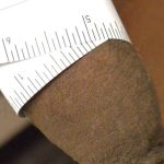 Permanent Penis Enlargement Before & After Patient #1431