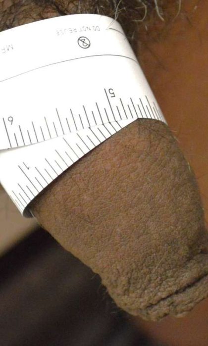 Permanent Penis Enlargement Before & After Patient #1431