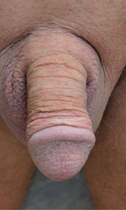 Permanent Penis Enlargement Before & After Patient #1434