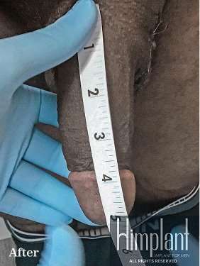 Himplant Before & After Patient #1275