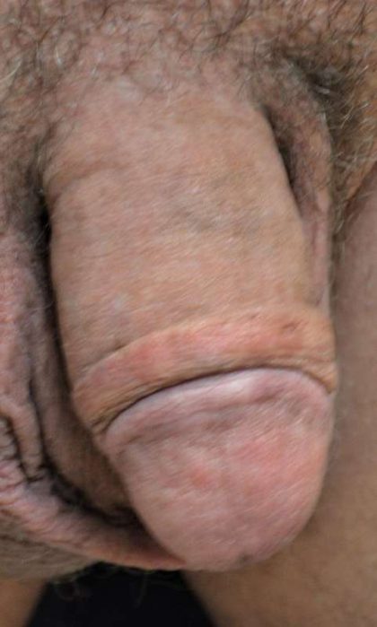 Permanent Penis Enlargement Before & After Patient #1437