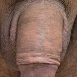 Permanent Penis Enlargement Before & After Patient #1440