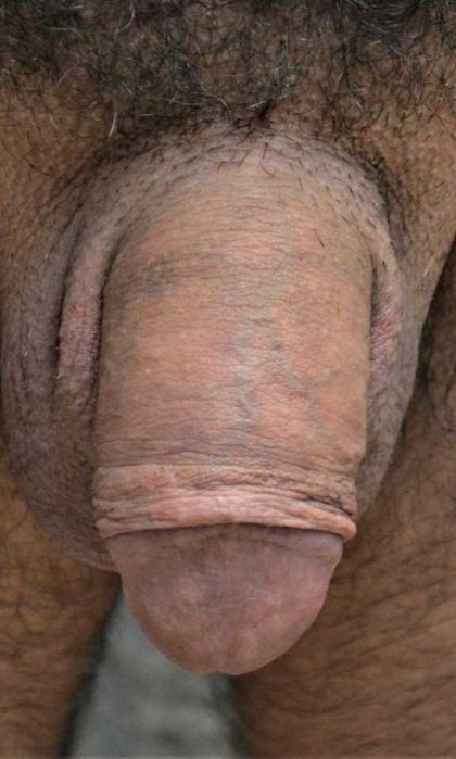 Permanent Penis Enlargement Before & After Patient #1440